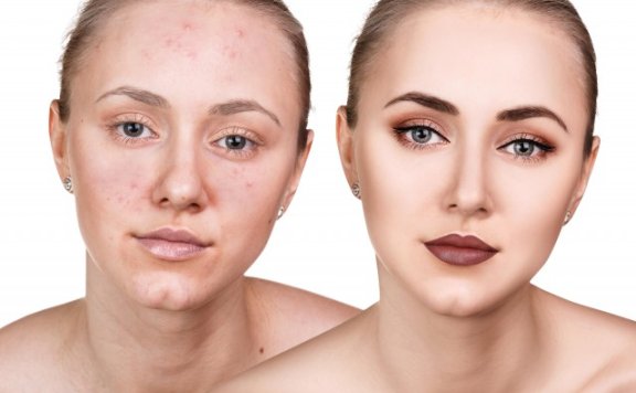 什么可以去黑头粉刺 彻底去黑头粉刺你需要这样做