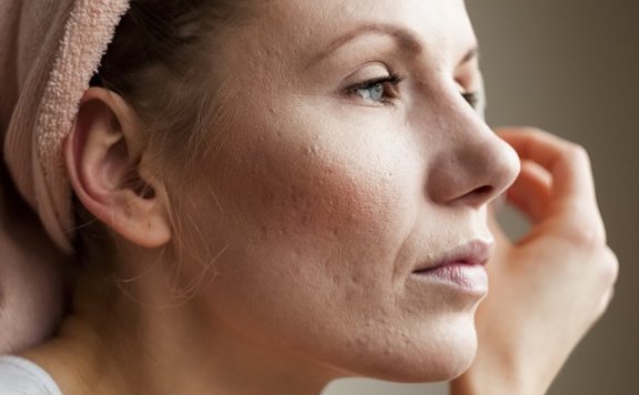 什么东西祛痘印最快 针对不同类型痘印的解决方法