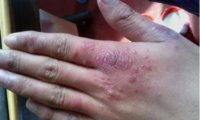 湿疹和癣的区别图片(区分图对比)