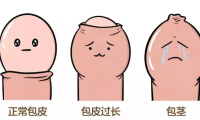 到底啥样的包皮需要割？出现这几种情况时…